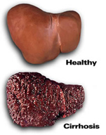 liver disease