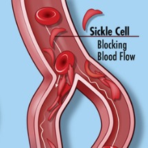 sickle cell